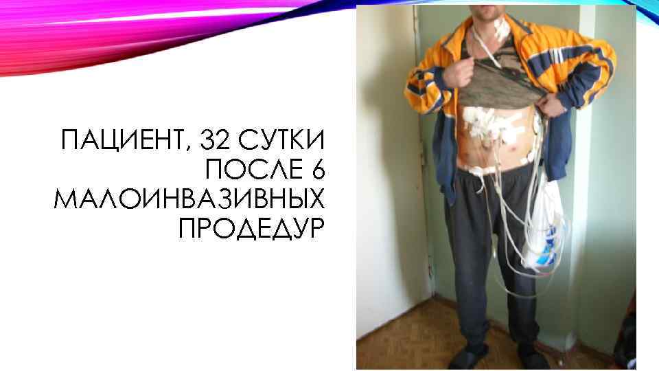ПАЦИЕНТ, 32 СУТКИ ПОСЛЕ 6 МАЛОИНВАЗИВНЫХ ПРОДЕДУР 