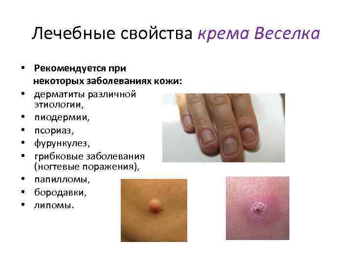 Лечебные свойства крема Веселка • Рекомендуется при некоторых заболеваниях кожи: • дерматиты различной этиологии,