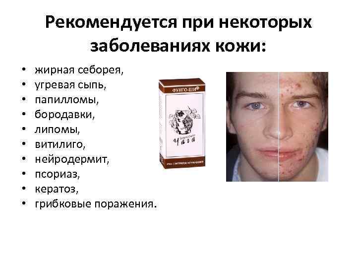 Рекомендуется при некоторых заболеваниях кожи: • • • жирная себорея, угревая сыпь, папилломы, бородавки,