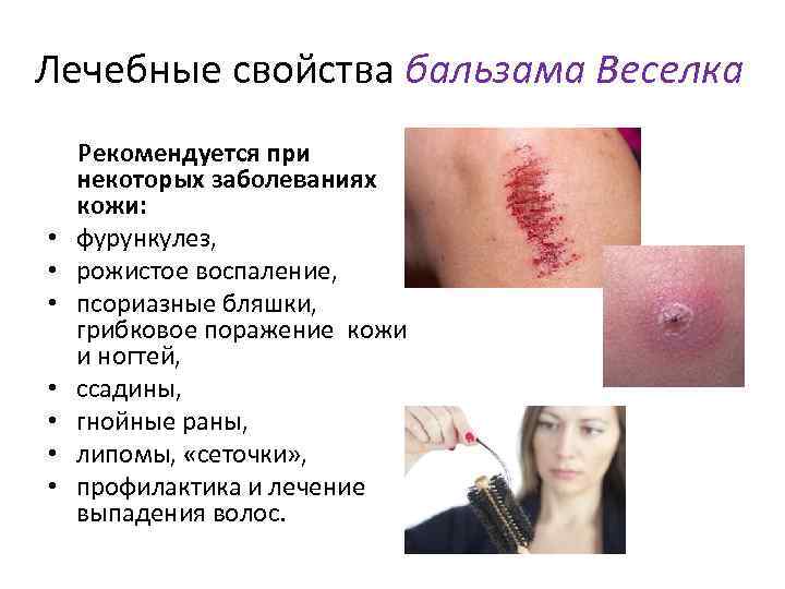 Лечебные свойства бальзама Веселка Рекомендуется при некоторых заболеваниях кожи: • фурункулез, • рожистое воспаление,