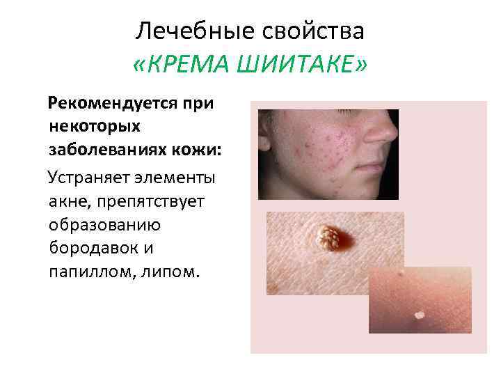 Лечебные свойства «КРЕМА ШИИТАКЕ» Рекомендуется при некоторых заболеваниях кожи: Устраняет элементы акне, препятствует образованию