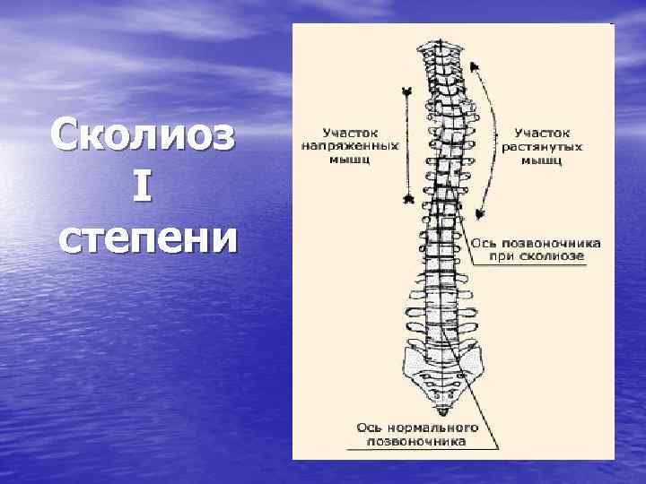 Сколиоз I степени 