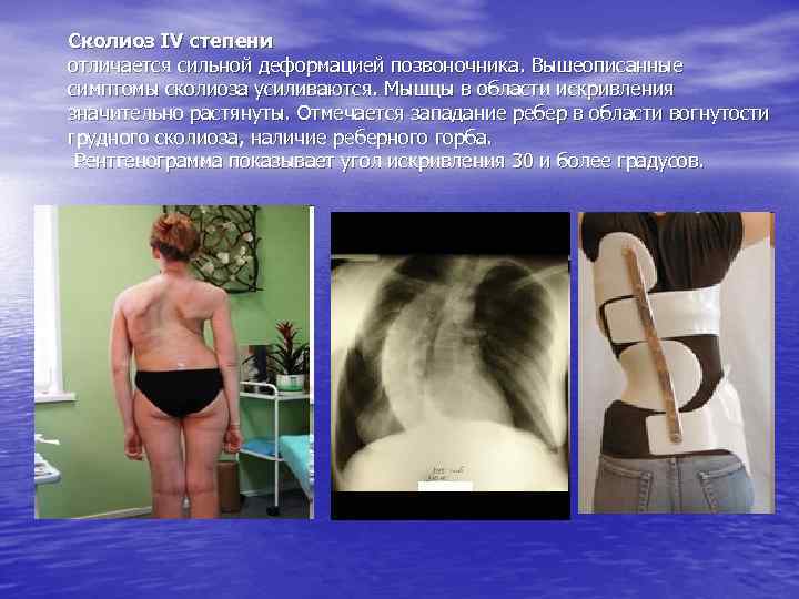 Сколиоз IV степени отличается сильной деформацией позвоночника. Вышеописанные симптомы сколиоза усиливаются. Мышцы в области