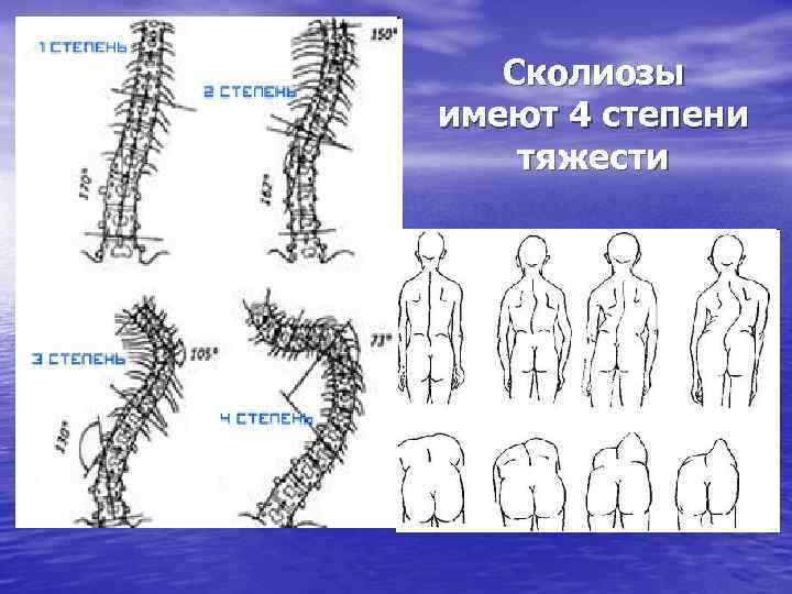 Сколиозы имеют 4 степени тяжести 