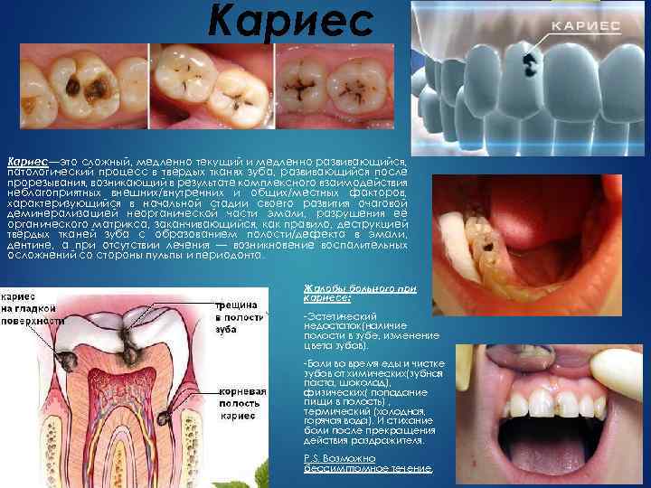 Кариес—это сложный, медленно текущий и медленно развивающийся, патологический процесс в твёрдых тканях зуба, развивающийся