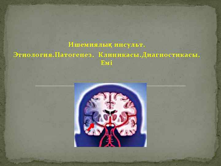 Ишемиялық инсульт. Этиология. Патогенез. Клиникасы. Диагностикасы. Емі 