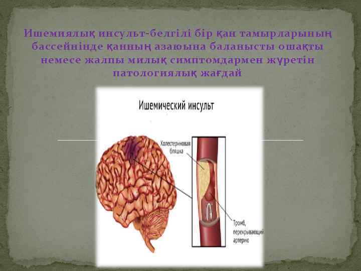 Ишемиялық инсульт-белгілі бір қан тамырларының бассейнінде қанның азаюына баланысты ошақты немесе жалпы милық симптомдармен