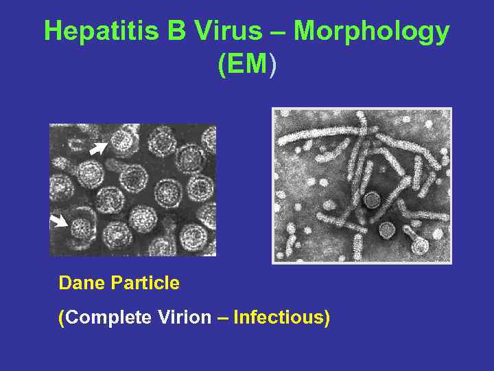 Hepatitis B Virus – Morphology (EM) Dane Particle (Complete Virion – Infectious) 