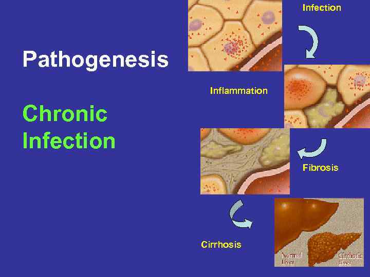 Infection Pathogenesis Inflammation Chronic Infection Fibrosis Cirrhosis 