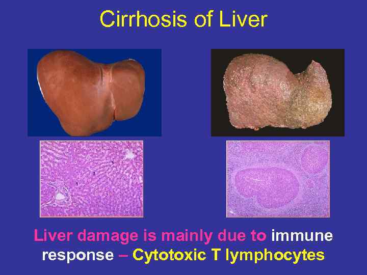 Cirrhosis of Liver damage is mainly due to immune response – Cytotoxic T lymphocytes