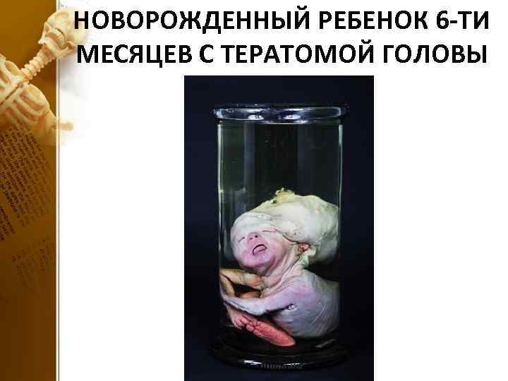 НОВОРОЖДЕННЫЙ РЕБЕНОК 6 -ТИ МЕСЯЦЕВ С ТЕРАТОМОЙ ГОЛОВЫ 