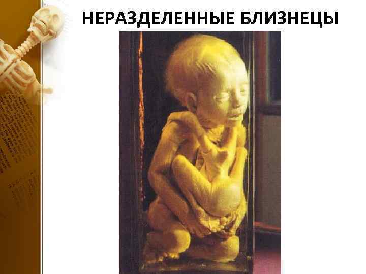 НЕРАЗДЕЛЕННЫЕ БЛИЗНЕЦЫ 