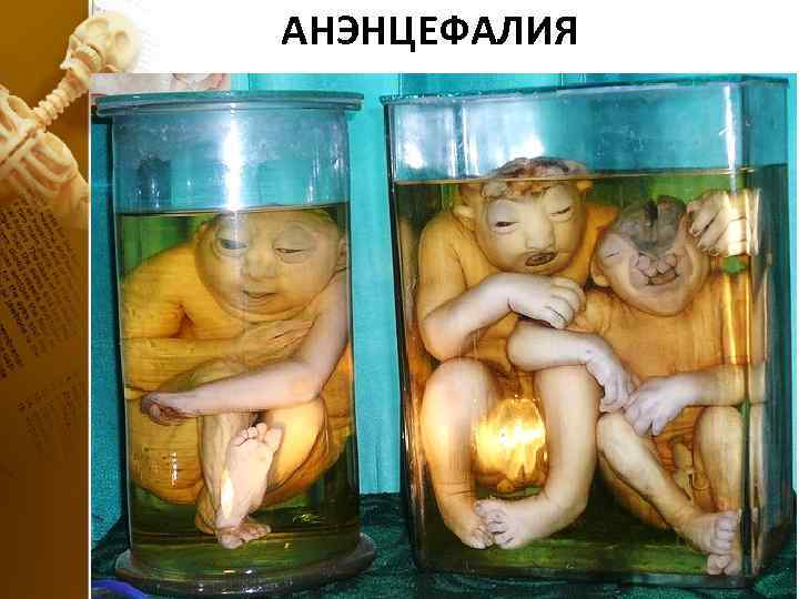 АНЭНЦЕФАЛИЯ 