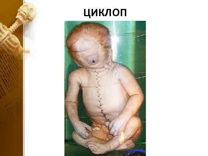ЦИКЛОП 