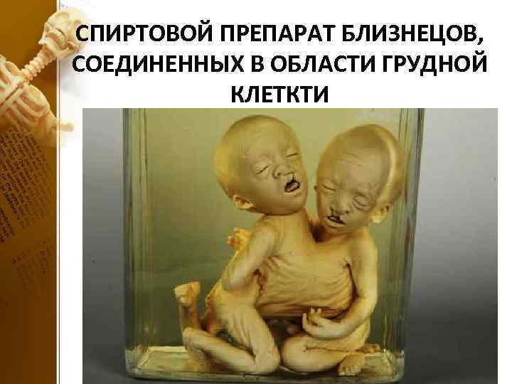 СПИРТОВОЙ ПРЕПАРАТ БЛИЗНЕЦОВ, СОЕДИНЕННЫХ В ОБЛАСТИ ГРУДНОЙ КЛЕТКТИ 
