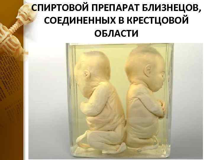 СПИРТОВОЙ ПРЕПАРАТ БЛИЗНЕЦОВ, СОЕДИНЕННЫХ В КРЕСТЦОВОЙ ОБЛАСТИ 