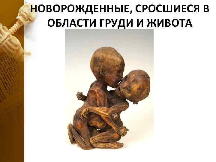 НОВОРОЖДЕННЫЕ, СРОСШИЕСЯ В ОБЛАСТИ ГРУДИ И ЖИВОТА 