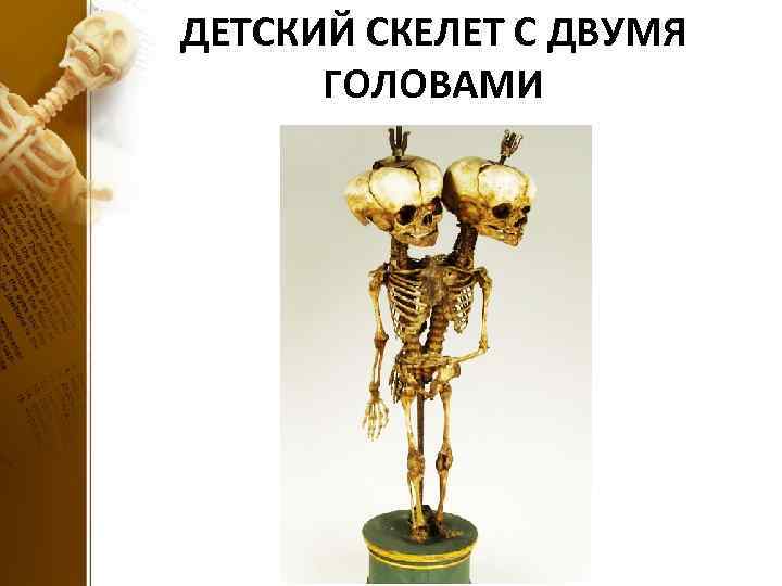 ДЕТСКИЙ СКЕЛЕТ С ДВУМЯ ГОЛОВАМИ 