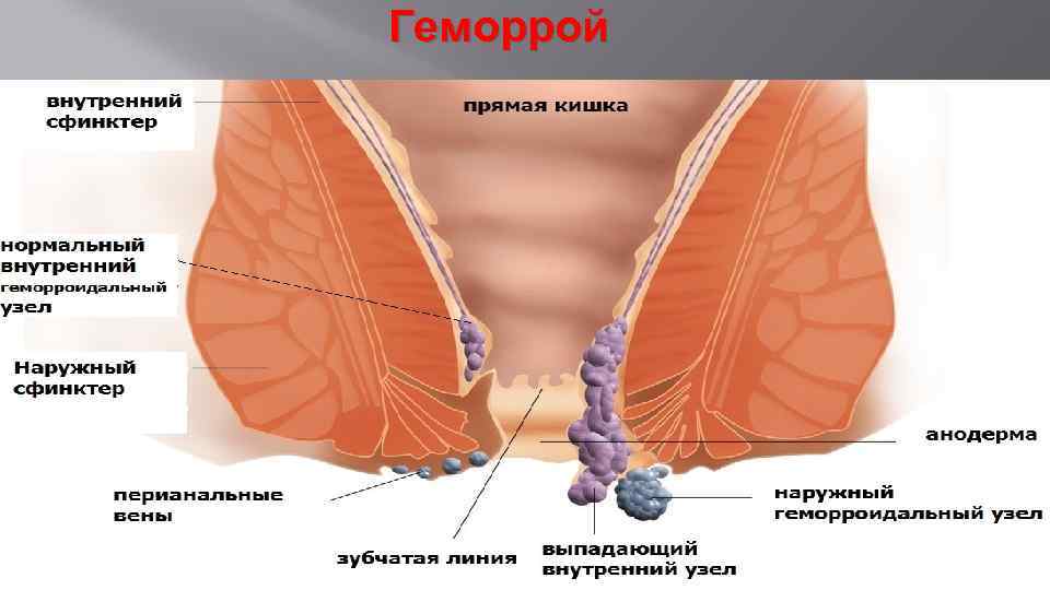 Геморрой 