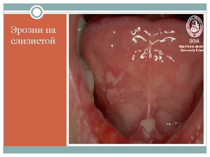 Эрозии на слизистой 