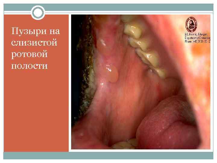 Пузыри на слизистой ротовой полости 