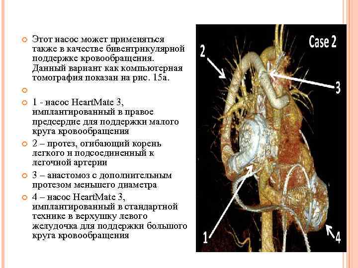  Этот насос может применяться также в качестве бивентрикулярной поддержке кровообращения. Данный вариант как