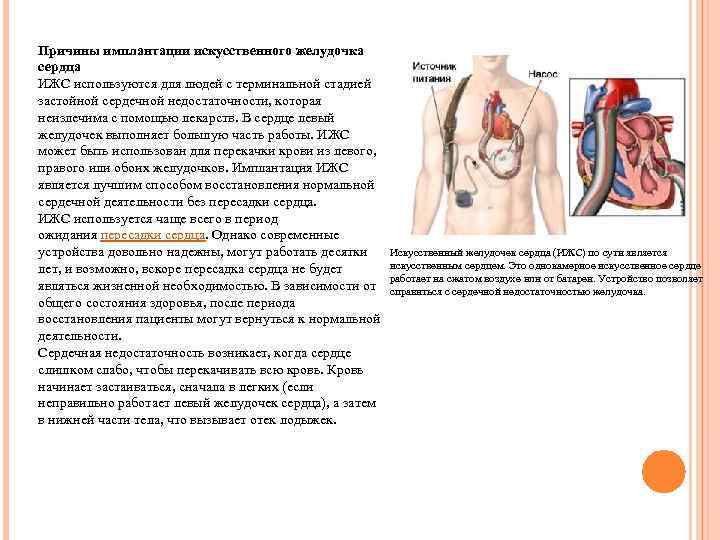 Причины имплантации искусственного желудочка сердца ИЖС используются для людей с терминальной стадией застойной сердечной
