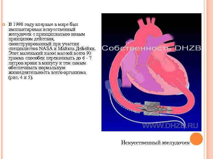  В 1998 году впервые в мире был имплантирован искусственный желудочек с принципиально новым