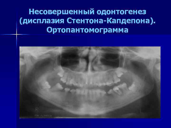 Несовершенный одонтогенез (дисплазия Стентона-Капдепона). Ортопантомограмма 