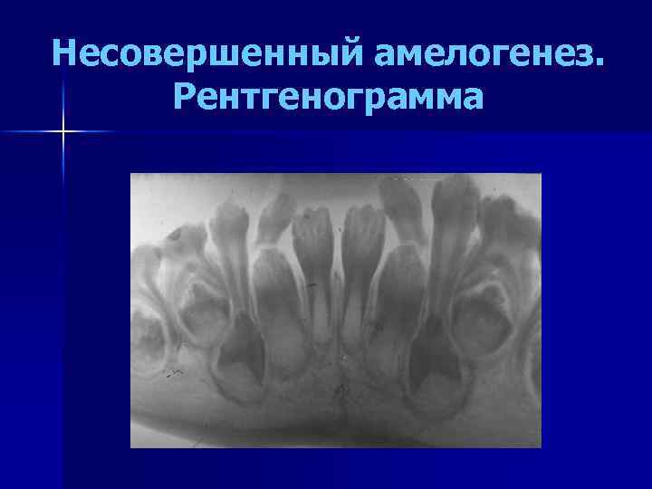 Несовершенный амелогенез. Рентгенограмма 