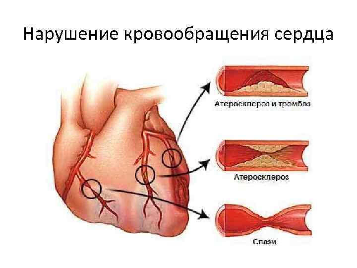 Нарушение кровообращения сердца 