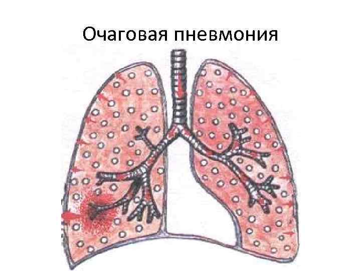 Очаговая пневмония 