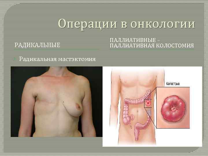 Операции в онкологии РАДИКАЛЬНЫЕ Радикальная мастэктомия ПАЛЛИАТИВНЫЕ – ПАЛЛИАТИВНАЯ КОЛОСТОМИЯ 