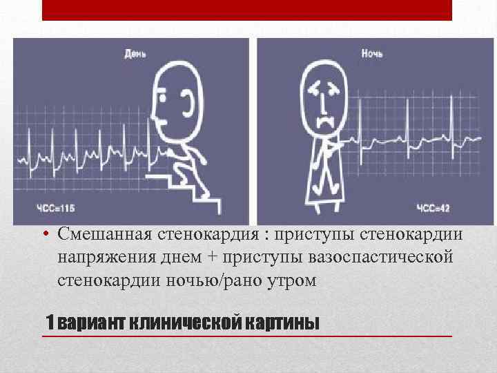  • Смешанная стенокардия : приступы стенокардии напряжения днем + приступы вазоспастической стенокардии ночью/рано