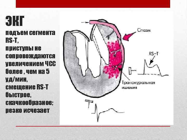 Подъем сегмента. Трансмуральная ишемия передней стенки ЭКГ. Трансмуральный инфаркт первичный. Принцметала на ЭКГ. Трансмуральный инфаркт ишемия.