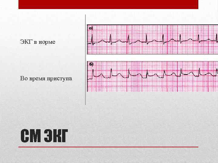 ЭКГ в норме Во время приступа СМ ЭКГ 