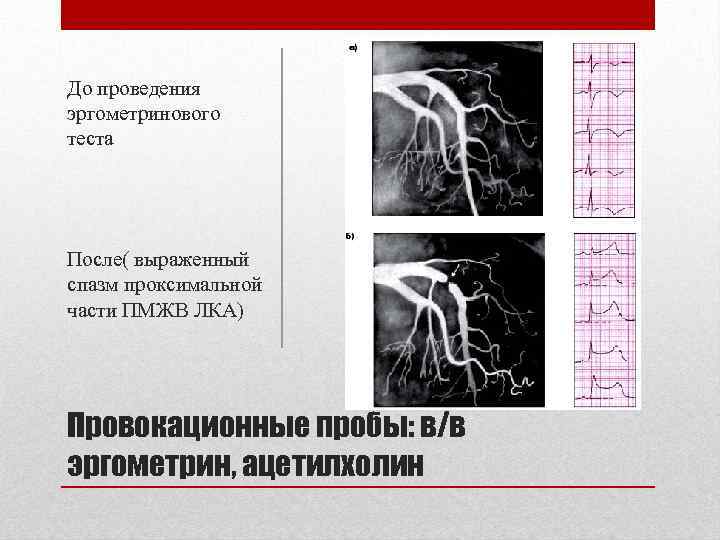 До проведения эргометринового теста После( выраженный спазм проксимальной части ПМЖВ ЛКА) Провокационные пробы: в/в