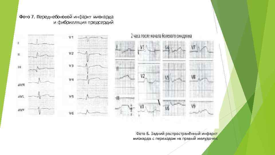 Фото 7. Переднебоковой инфаркт миокарда и фибрилляция предсердий Фото 8. Задний распространённый инфаркт миокарда