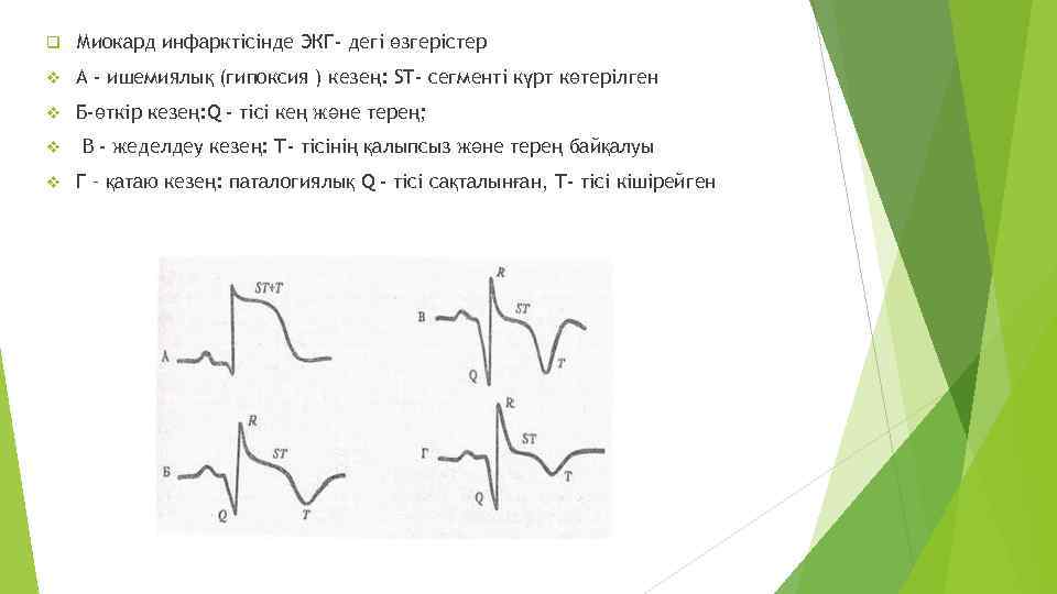 q Миокард инфарктісінде ЭКГ- дегі өзгерістер v А - ишемиялық (гипоксия ) кезең: ST-