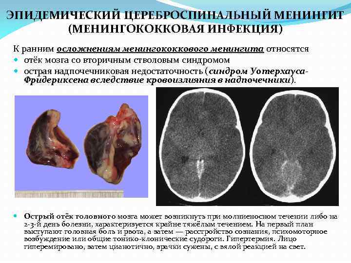 Менингит спинного мозга фото