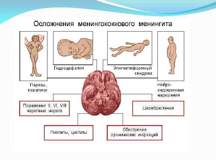 Асептический менингит фото