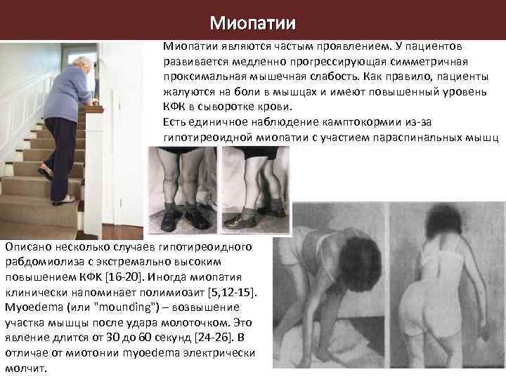 Миопатии являются частым проявлением. У пациентов развивается медленно прогрессирующая симметричная проксимальная мышечная слабость. Как
