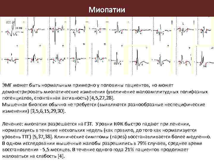 Миопатии ЭМГ может быть нормальным примерно у половины пациентов, но может демонстрировать миопатические изменения