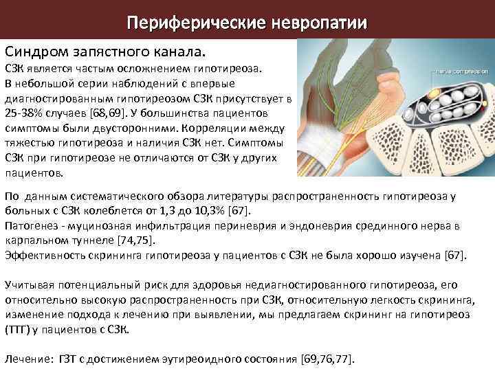 Периферические невропатии Синдром запястного канала. СЗК является частым осложнением гипотиреоза. В небольшой серии наблюдений