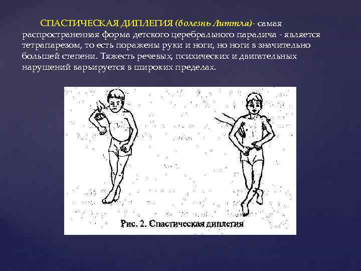 СПАСТИЧЕСКАЯ ДИПЛЕГИЯ (болезнь Литтла)- самая распространенная форма детского церебрального паралича - является тетрапарезом, то