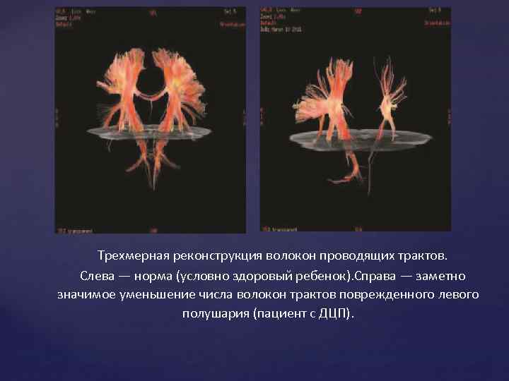 Трехмерная реконструкция волокон проводящих трактов. Слева — норма (условно здоровый ребенок). Справа — заметно
