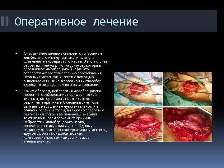 Оперативное лечение становится спасением для больного и в случаях значительного сдавления малоберцового нерва. В