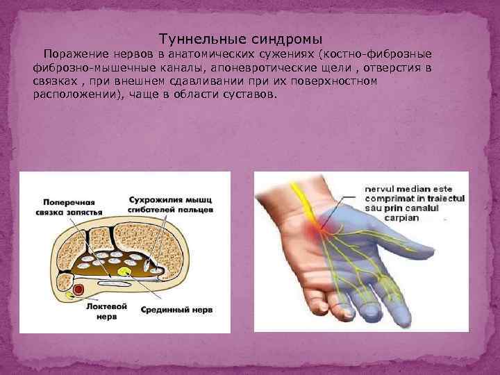 Туннельные синдромы Поражение нервов в анатомических сужениях (костно-фиброзные фиброзно-мышечные каналы, апоневротические щели , отверстия