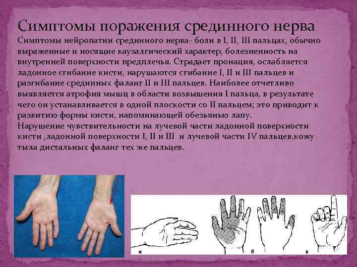 Симптомы поражения срединного нерва Симптомы нейропатии срединного нерва- боли в I, III пальцах, обычно