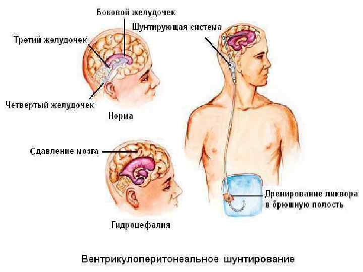 Водянка головного мозга у взрослого лечение. Шунт головной мозг ликвора. Шунтирование желудочков мозга. Шунт в головном мозге при гидроцефалии. Шунт для отвода ликвора.